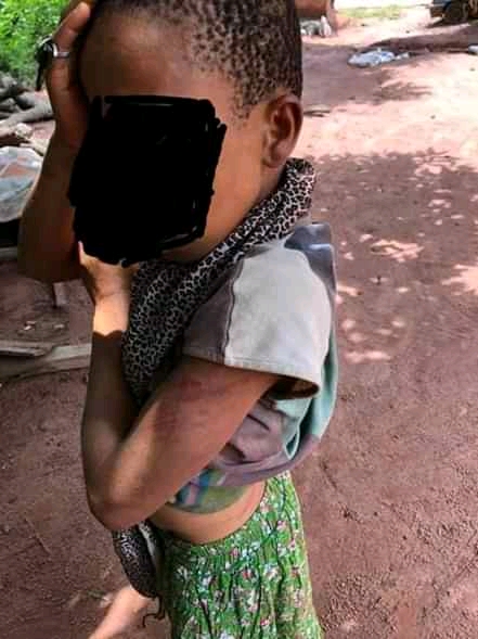 Woman Inflicts Injuries On Her Stepdaughter In Enugu (Photo)